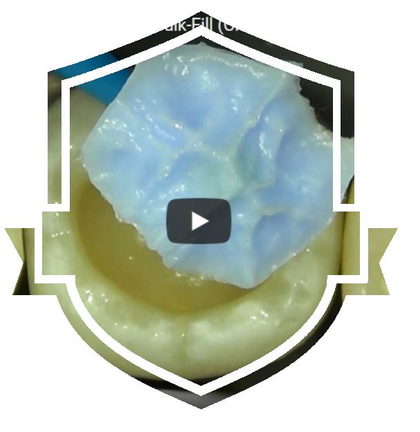 Okklusionsstempel: Natürliche Okklusionsflächen auf Composite-Restaurationen kopieren