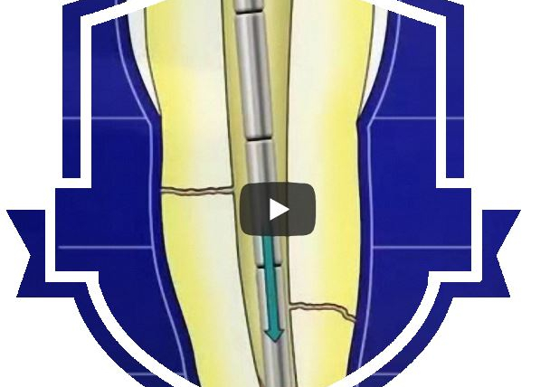 Vertikale thermoplastische Kondensation nach Schilder – schematisch und step by step