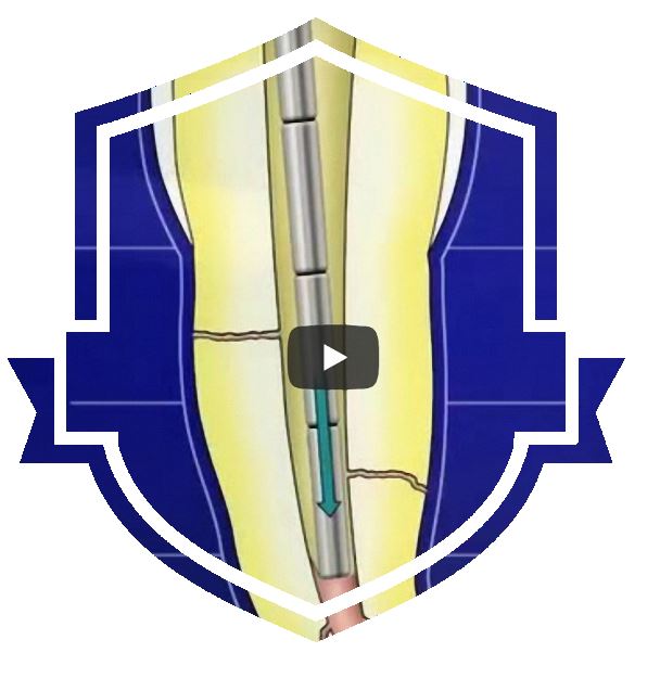 Vertikale thermoplastische Kondensation nach Schilder – schematisch und step by step