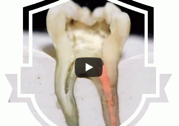 Vertikale thermoplastische Kondensation nach Schilder – Profilschnitt step by step